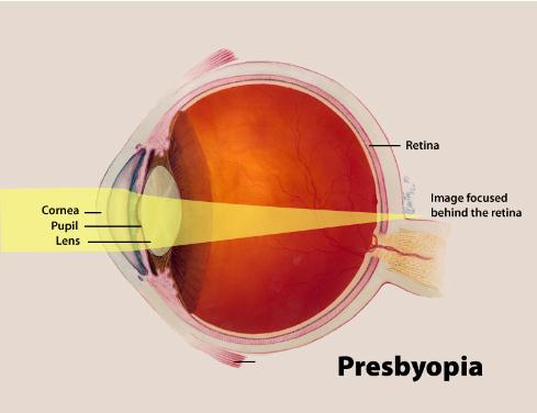 presbyopia jelentése magyarul